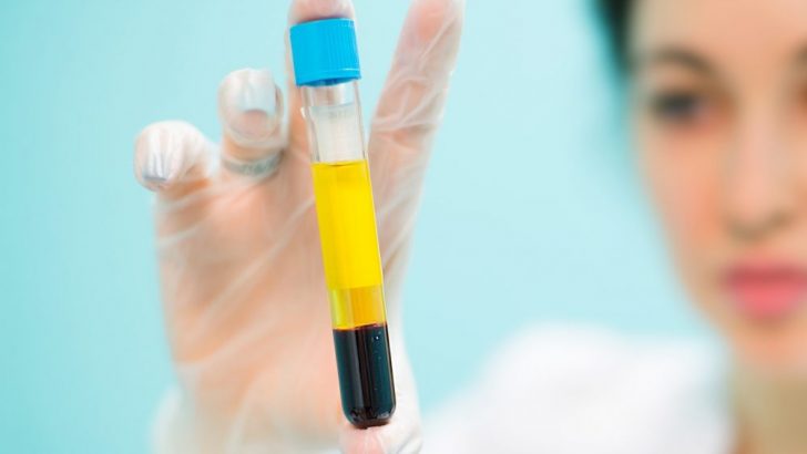 ما هو PRP؟ طريقة PRP في أطفال الأنابيب